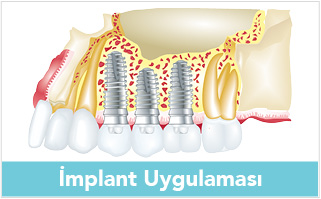implant-uygulamasi-banner